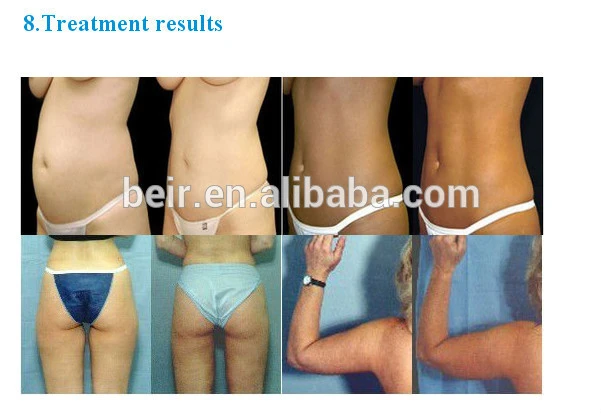 RU56 treatment results.jpg