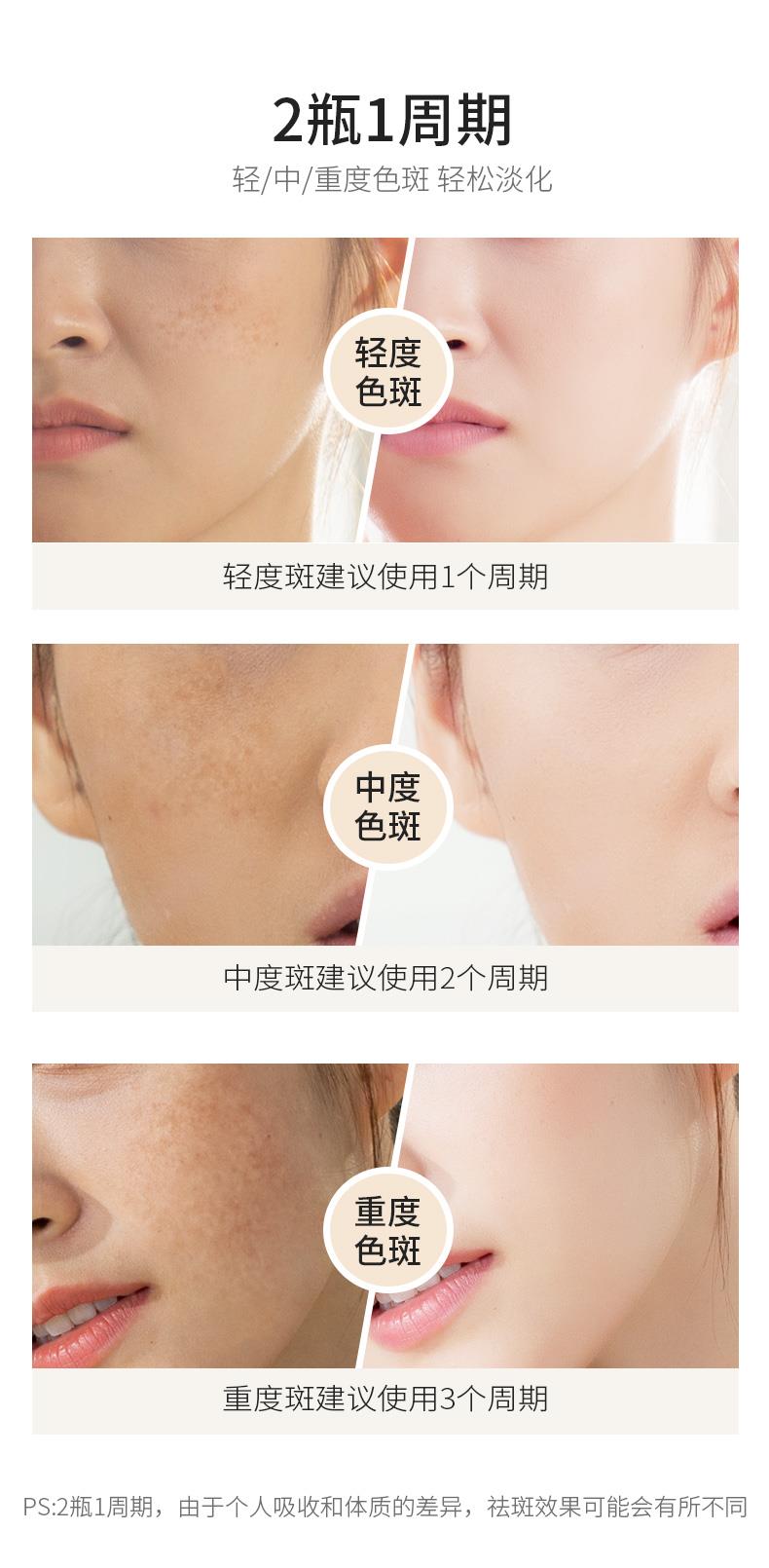 OEM ODM Beauty Anti Freckle Treatment Removal Cream Freckle Whitening Cream