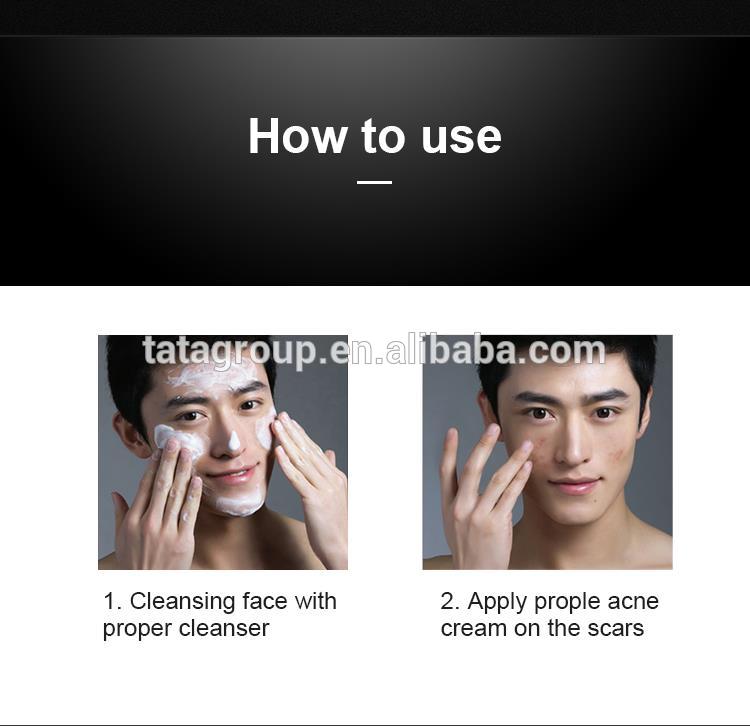 Custom Logo Private Label Remove Acne Pimples Herbal Anti-acne Cream