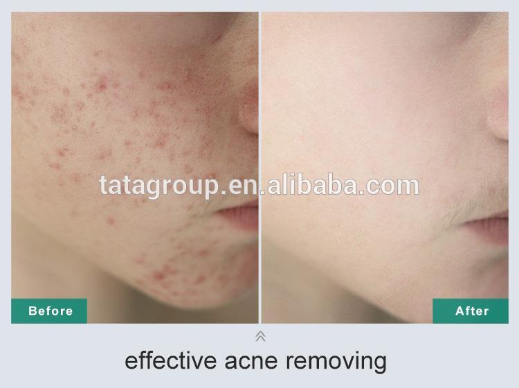 Private Label Facial Oil Control Anti Acne Cleanser
