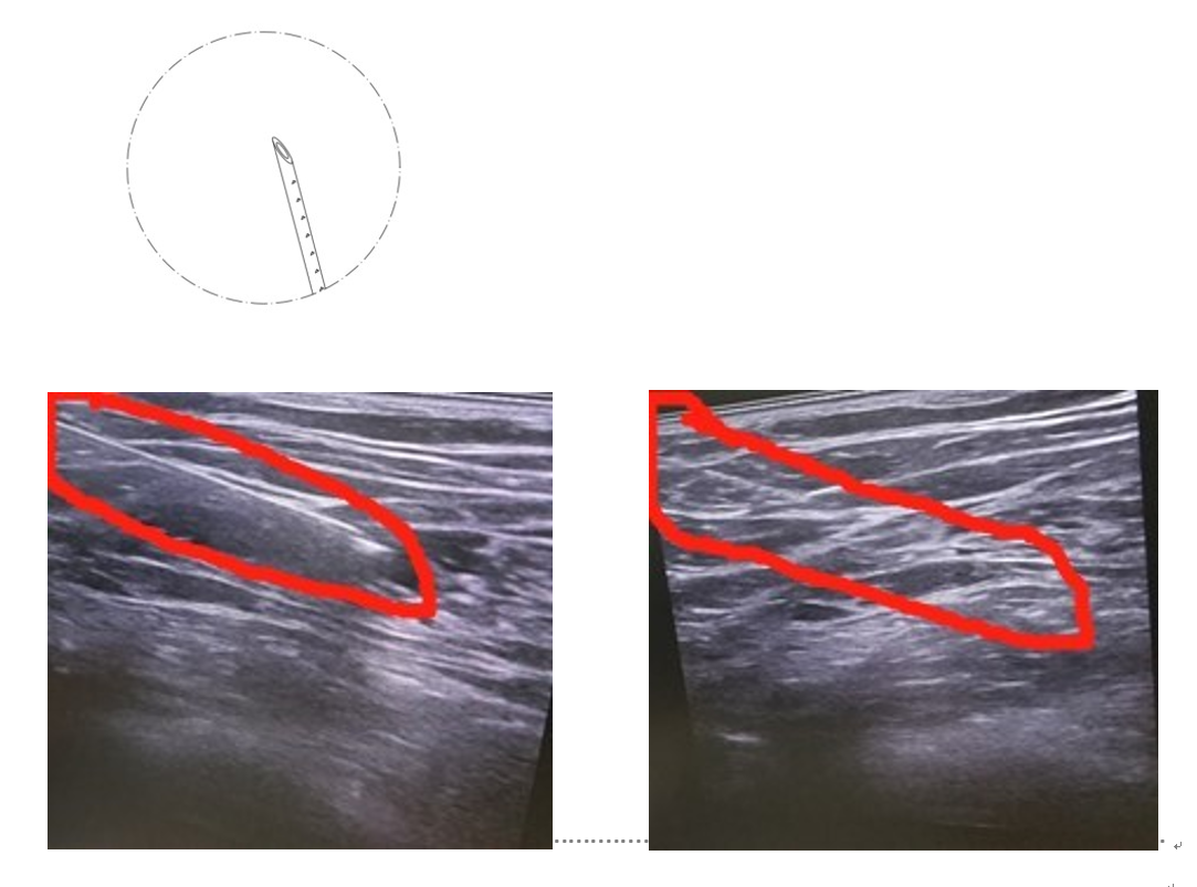 nerve block cannula-1.png