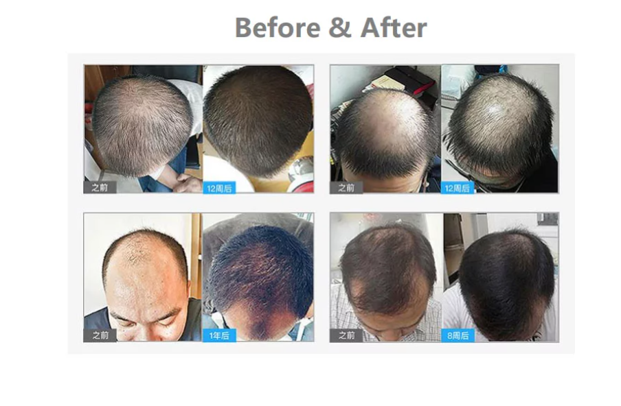 Hair Regrowth Cap